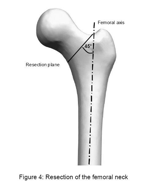 Approach to the hip joint Any approach to the hip joint deemed appropriate by the surgeon is possible.