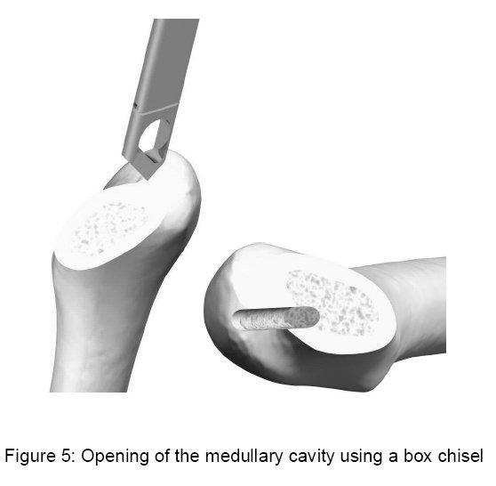 Opening of the medullary cavity Open the medullary cavity using a box chisel.