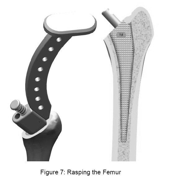 Preparation of the femoral shaft Once the medullary cavity has been opened, rasping to open the femoral shaft can be started (Figure 7).