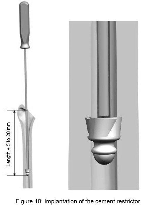 Implantation of the cement restrictor The cement restrictor is placed depending on the measured diameter of diaphyseal medullary cavity.