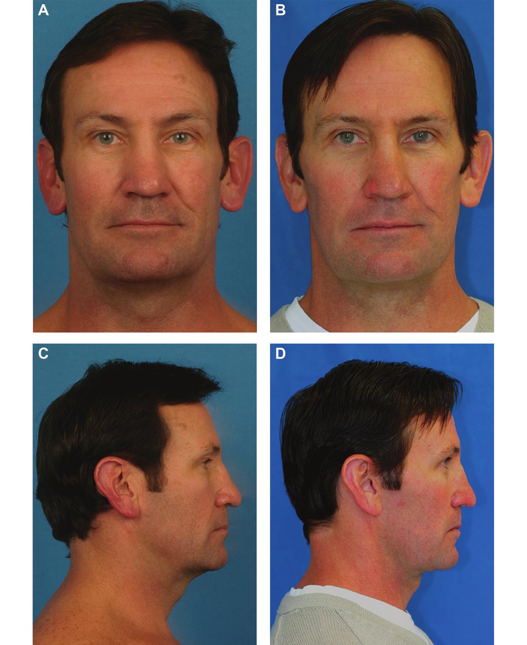 Mueller et al 21 Figure 16. (A, C) This 46-year-old man presented with an aging neck, platysmal banding, and skin laxity.