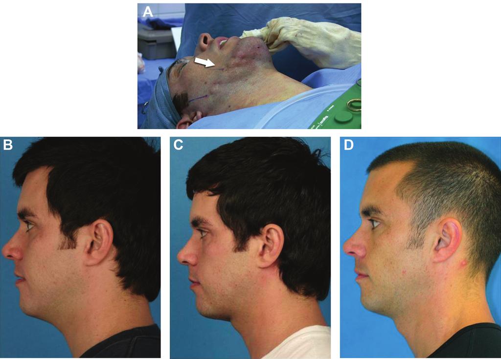 Mueller et al 23 not seen as a replacement for traditional neck rejuvenation procedures, and it does not remove excess skin. Disclosures Dr. Gregory P.