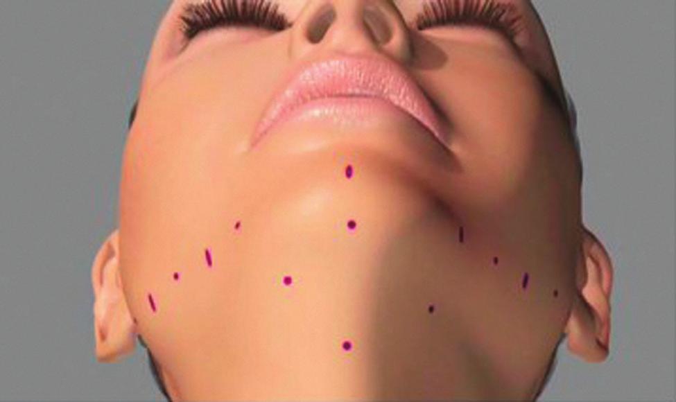 This maneuver is essential, as it exposes raw surfaces that will form scar tissue, allowing adherence of the neck skin to the underlying platysma muscle.