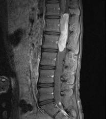Pediatric spine masses Key to differential diagnosis is to identify the location 35% 15%