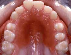 Prolems relted to pplince hygiene, such s Cndid licns infection cusing inflmmtion to the pltl tissues on the fitting surfce of the pplince (Figure 4), re not uncommon.