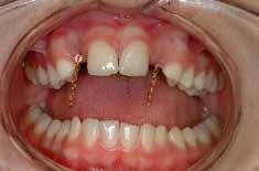 Figure 14. Adominl x-ry tken to locte foreign ody. nd these re n invlule guide tht should e ville in every dentl prctice.