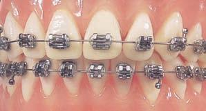 Frequently Asked Questions Q: What if the bands or brackets become loose? Answer: The seal created by the cement has broken. Call the orthodontist s office and schedule an appointment.