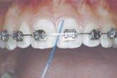 Place bristles where gums and teeth
