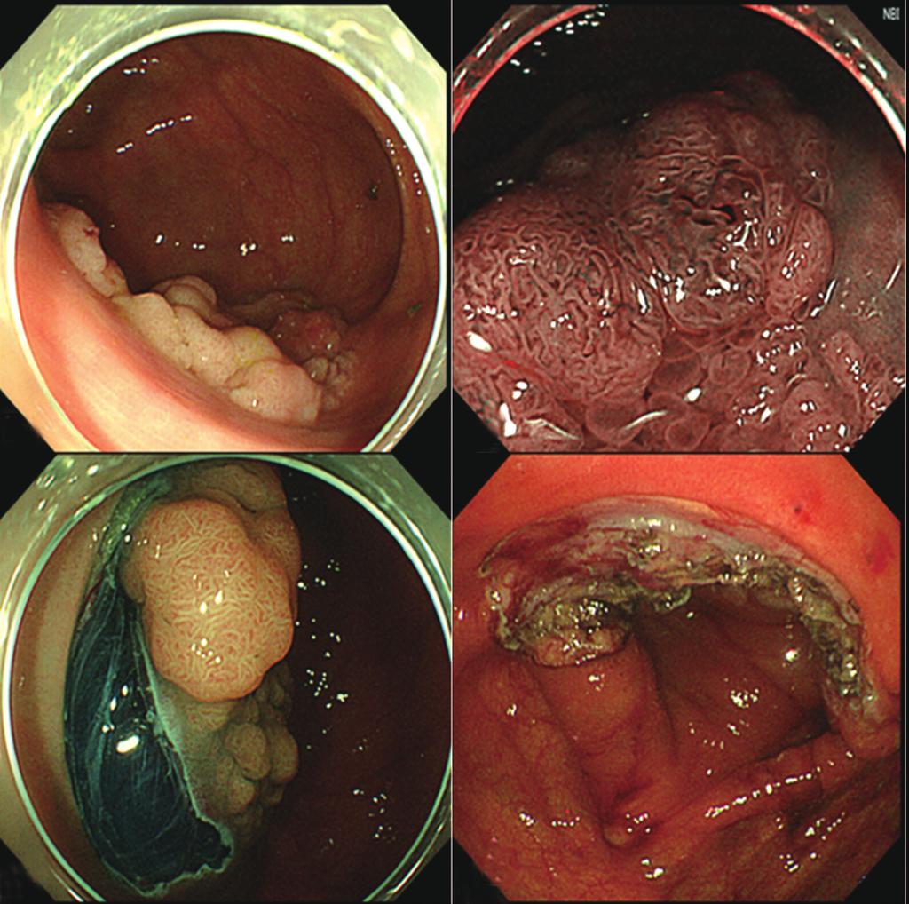Q260AZI endoscopy (Olympus, Tokyo, Japan) with narrow-band imaging, and then were sprayed with 0.4% indigo carmine.