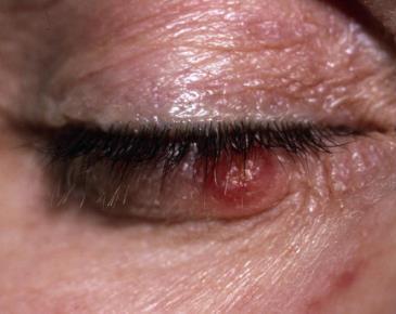 Solitary, firm, erythematous/ pearly nodules or plaques May be ulcerated/