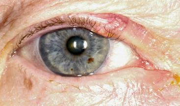 commonest sites, particularly periocular area 40% involve eyelids Usually