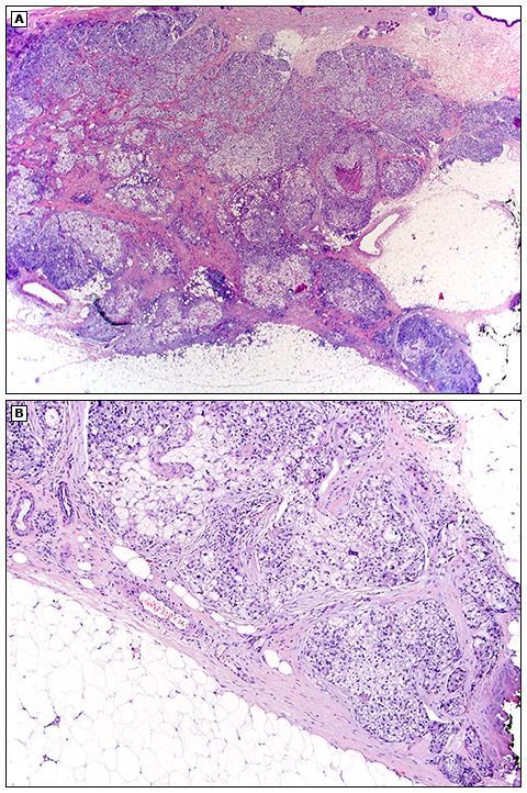 Asymmetry and lack of circumscription Neoplastic cells (basaloid,