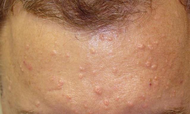 Similar clinically with sebaceous