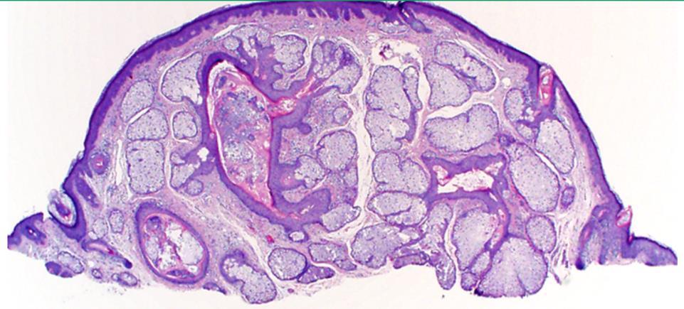 Sebaceous hyperplasia Multiple sebaceous lobules composed of
