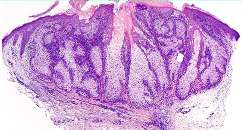 Sebaceous adenoma Lacks a central follicle Connect directly to epidermis Well-circumscribed, multilobular