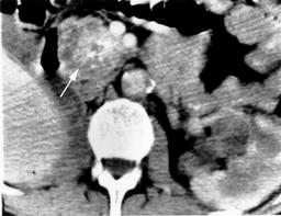Thin-walled capsule on CT Sun-burst calcifications