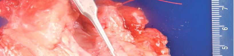 Intraductal Papillary Mucinous Neoplasm (IPMN) 1% of all pancreatic neoplasms