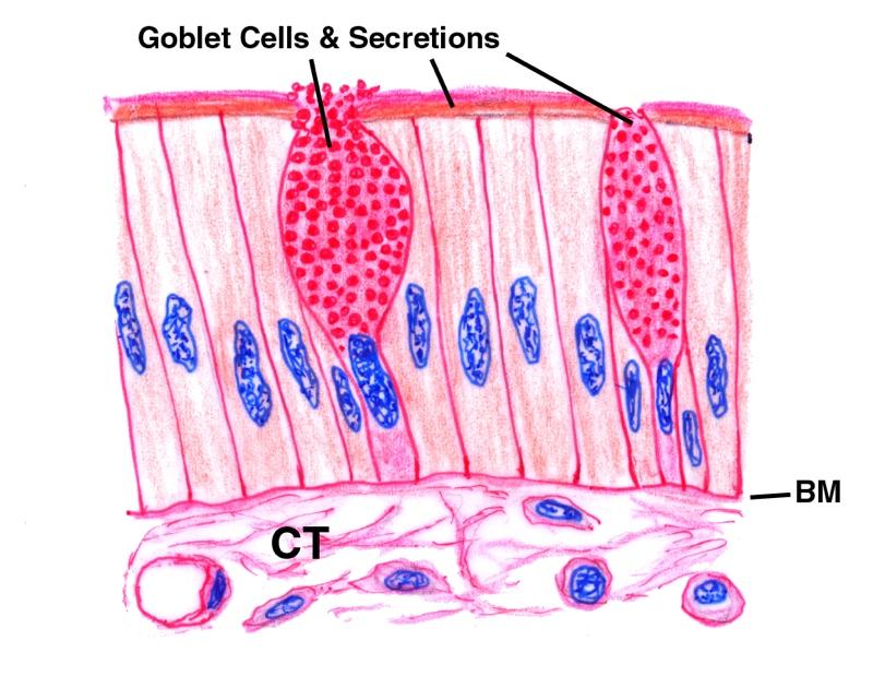 cystoadenocarcinomas More goblet cells in