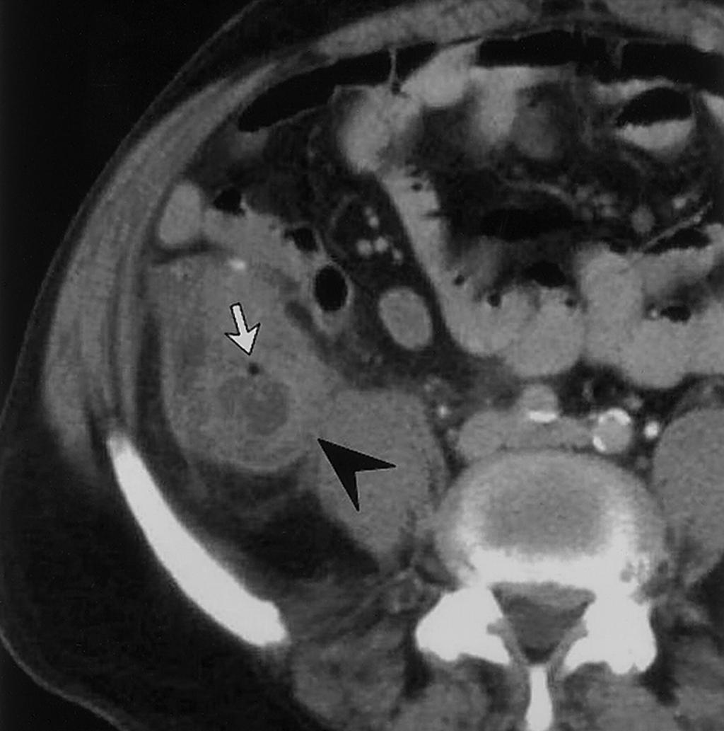 Suspected Appendiceal Neoplasm A CT scan was performed Complex cystic appendix with thickened wall