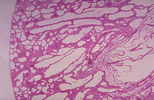 Here is the histology of CPKD ; we can see that there are the collecting tubules dilated & they are arranged perpendicular to the renal cortex & nothing is bulging outside (smooth surface)