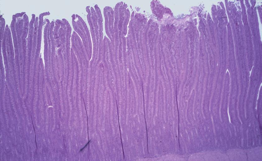 Moderate erosion of the villi tips with loss of villi material into the gut.