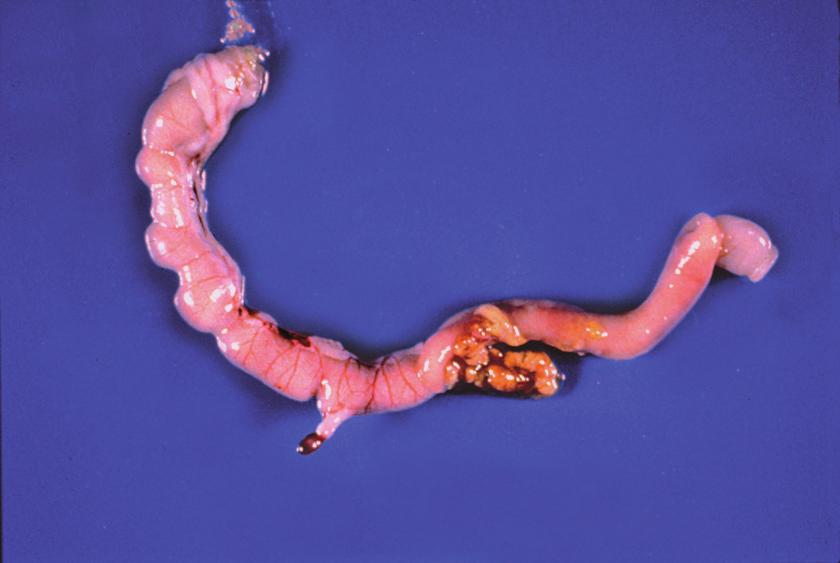 The serosal surface may be speckled with numerous red petechiae, and the intestine may