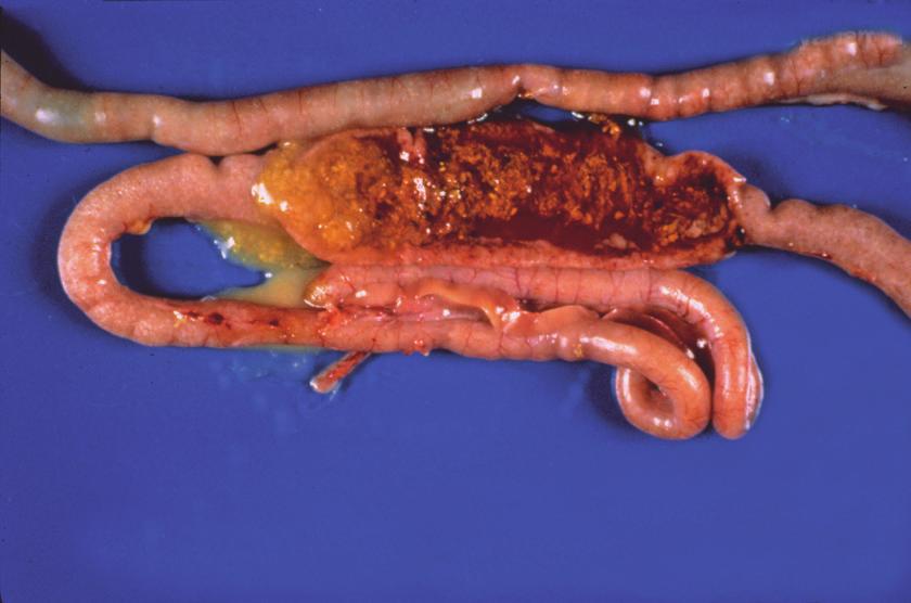 necatrix There is extensive hemorrhage into the lumen of the intestine and the serosal surface is