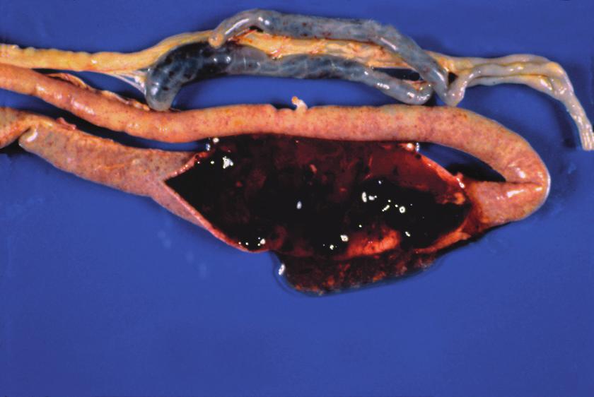 The serosal surface is rough and thickened with many pinpoint hemorrhages.