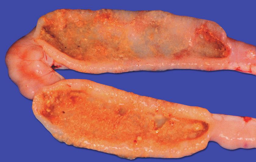 Necrotic Enteritis Dilated small intestine contains yellow-brown, watery, foul smelling