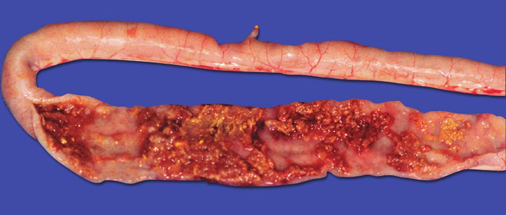 Extensive areas of necrosis and ulceration. Flecks of blood are present.