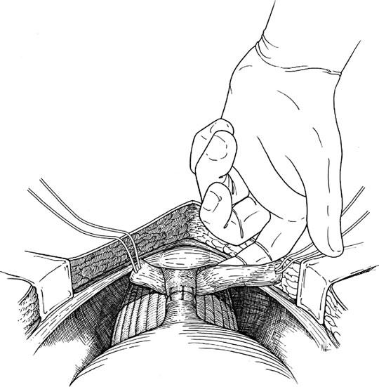 WESTNEY ET AL. 2 3 cm lateral to midline at the inferior end of the incision.