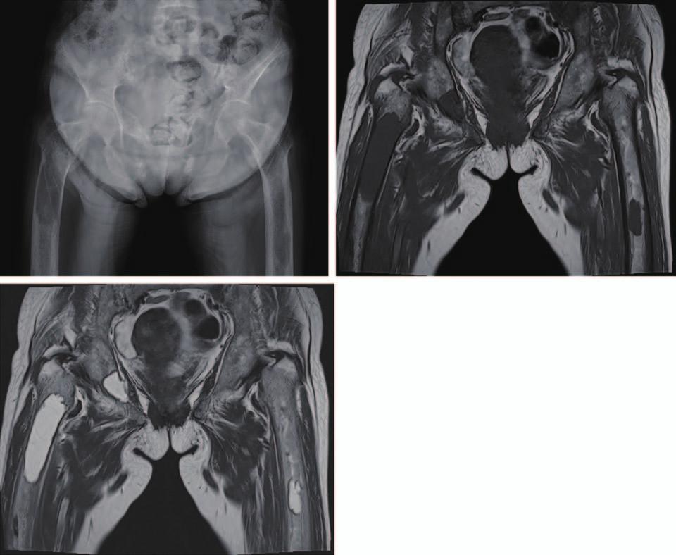 Hip Pelvis 28(3): 173-177, 2016 A B developed in the proximal femur of a patient with brown tumor so we report the treatment results along with a literature review. CASE REPORT C Fig. 1. X-ray findings at the time of hospital visit.