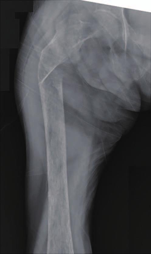 A 57-year-old female patient came to the hospital with pain in both thighs, especially on the right side. The pain was exacerbated during weight bearing and walking and decreased while resting.