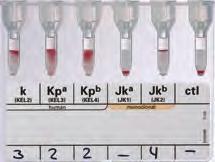 For such cases, the rapid availability of fully typed donor blood is of great advantage. The ID-System facilitates complete antigen profiling.