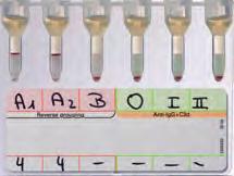 Reverse Grouping IMMUNOHEMATOLOGY 33 Reverse Grouping with Antibody Screening The ID-Card Reverse Grouping with Antibody Screening is used with the test cell reagents ID-DiaCell ABO/I-II or