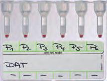 34 IMMUNOHEMATOLOGY Direct AHG Test (DAT) LISS/Coombs The most important function of the polyspecific AHG reagent is to detect the presence of IgG.