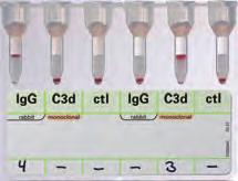 Direct AHG Test (DAT) IMMUNOHEMATOLOGY 35 A positive direct antiglobulin test (DAT) with polyspecific antihuman globulin (AHG) generally indicates that the red cells are coated in vivo with