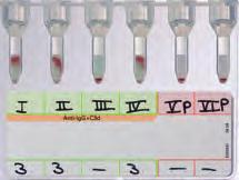 Antibody Screening IMMUNOHEMATOLOGY 37 DiaScreen ID-Card DiaScreen consisting of 4 microtubes containing polyspecific AHG for the IAT and 2 microtubes containing neutral gel for the two-stage enzyme