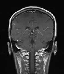 wholebrain radiation 15 months prior to study entry and SRS of