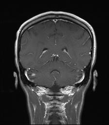 of CNS lesion shrinkage after 2 cycles of ONT- 380 +