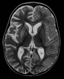 Photo 2: T2 weighted MRI showing