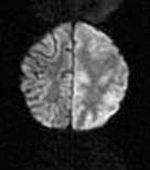 Flair brain images: Bilateral and