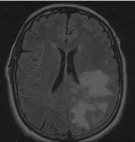 Photo 5: FLAIR sequence shows hyperintense signal involving periventricular, subcortical white matter and grey matter on left side.