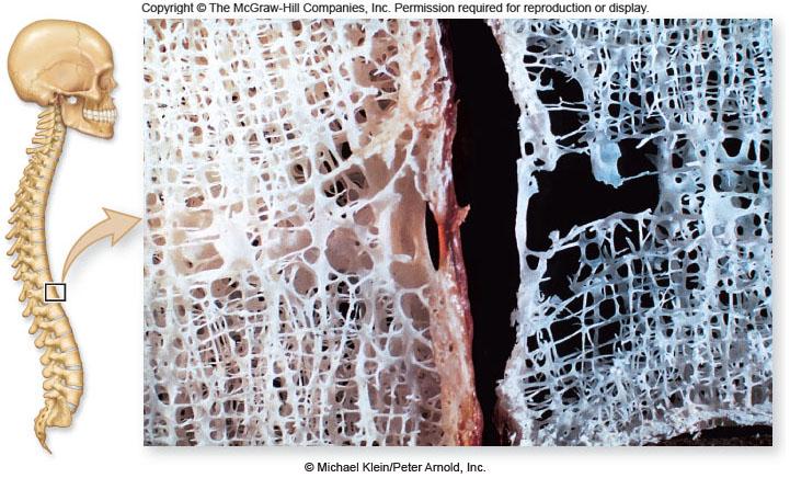 Osteoporosis bones lose more calcium than they add as a person ages,