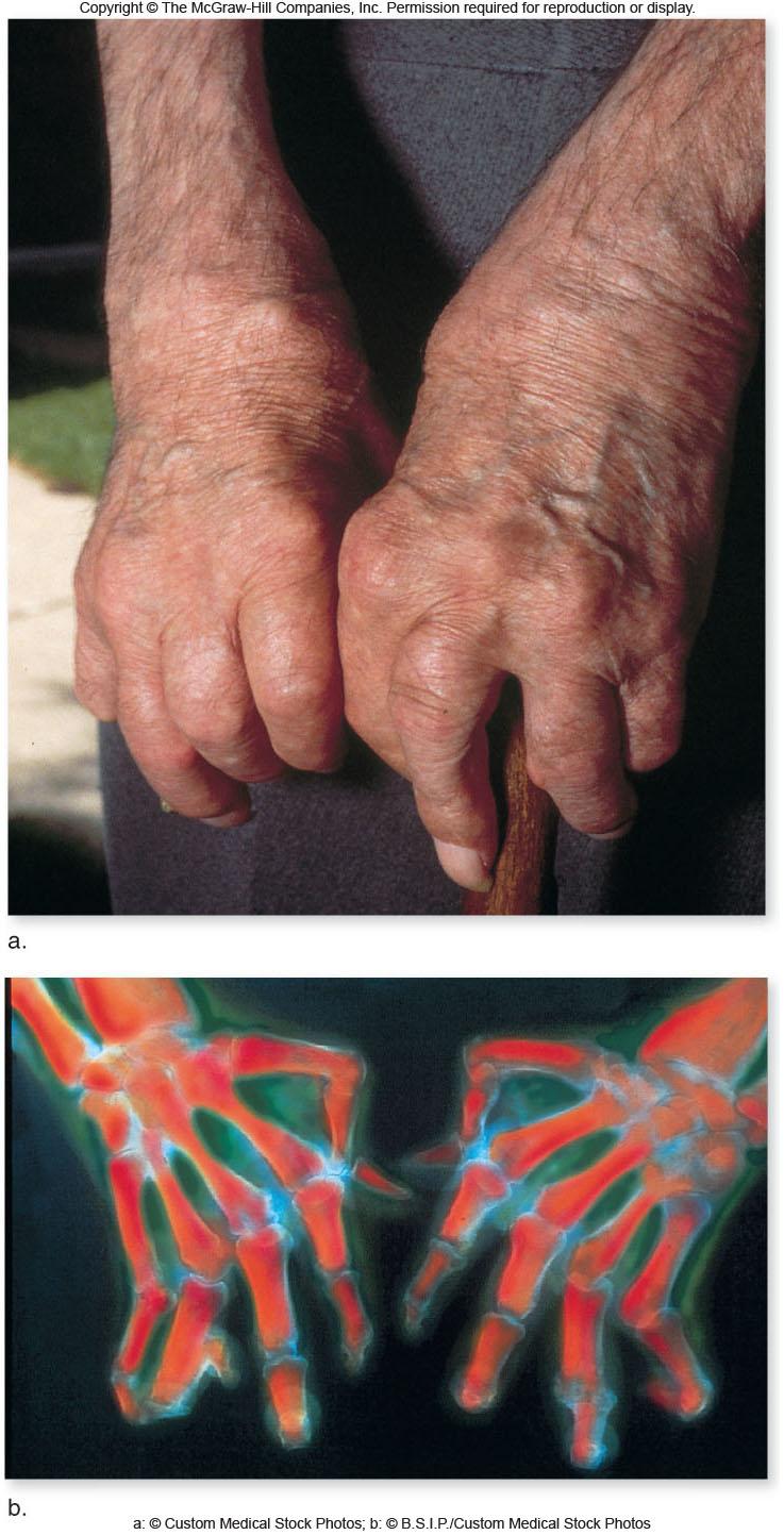 Rheumatoid arthritis is a debilitating autoimmune