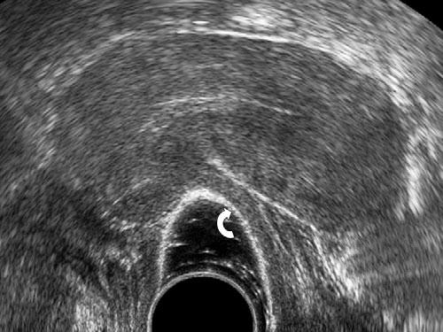 Transvaginal tenderness-guided ultrasonography using an acoustic window between the transvaginal probe and the surrounding vaginal structures by increasing the amount of ultrasound gel inside the