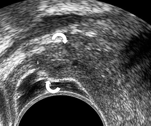 In addition, because the endometriotic nodule itself can induce pain, they asked patients to indicate during the ultrasonographic examination which points felt tender under gentle pressure of the