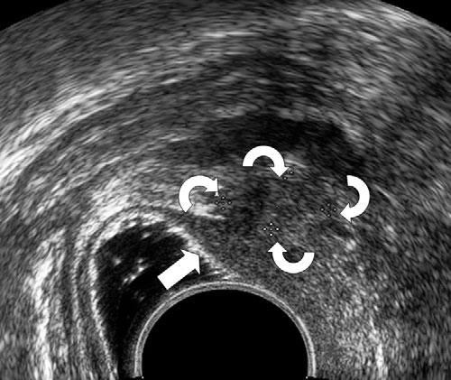 No studies have been reported illustrating the role of this new technique in the identification of different locations of deep endometriosis.