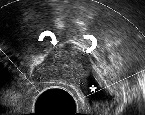 Guerriero et al. deep endometriosis). The findings at modified transvaginal ultrasonography were compared with the findings at surgery with histopathological confirmation of presence of endometriosis.