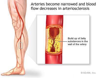Arterial Disease Clotting Shower of clots (small/large